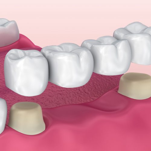 Dental Bridge Moldova