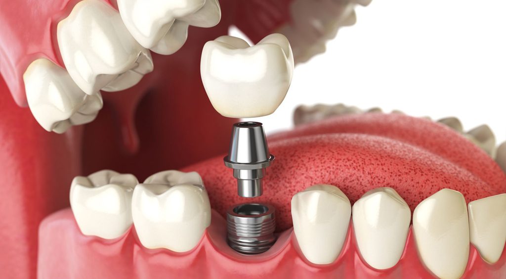 HOW MUCH ARE DENTAL IMPLANTS IN REPUBLIC OF MOLDOVA?