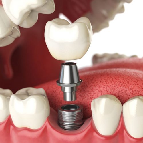 HOW MUCH ARE DENTAL IMPLANTS IN REPUBLIC OF MOLDOVA?
