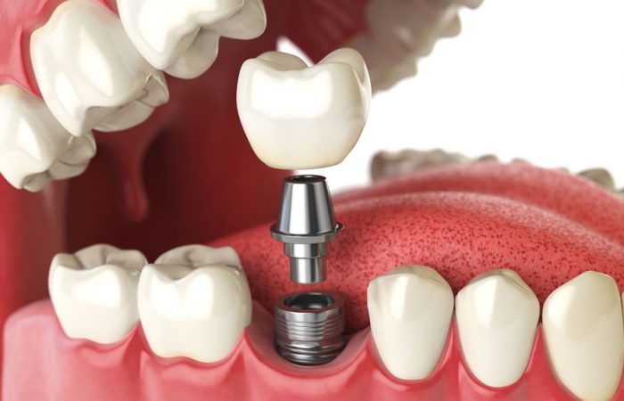 HOW MUCH ARE DENTAL IMPLANTS IN REPUBLIC OF MOLDOVA?