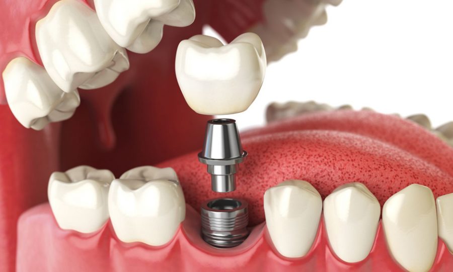 HOW MUCH ARE DENTAL IMPLANTS IN REPUBLIC OF MOLDOVA?